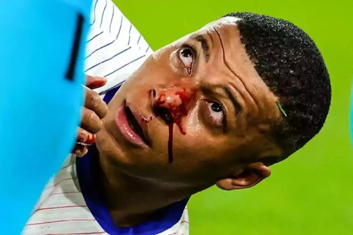 Mbappé lesionado de la nariz