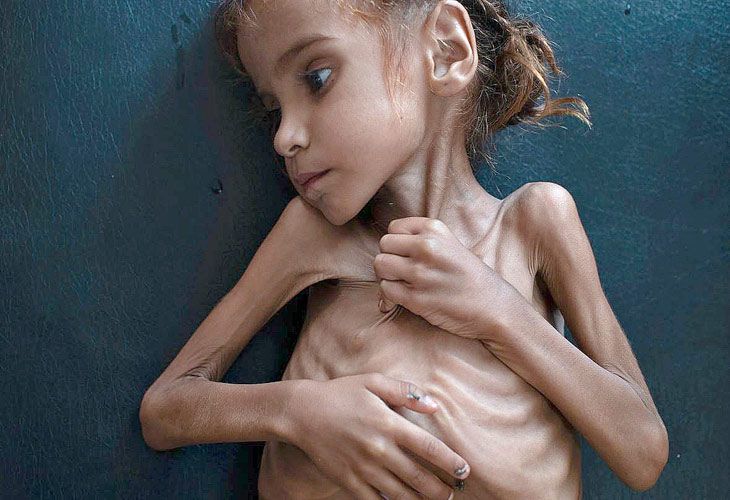 Muere la niña que fue el rostro de la hambruna de Yemen. ¡No tienen perdón!