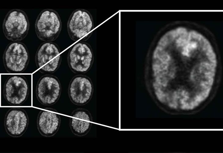 El Alzheimer podría ser detectado con seis años de margen