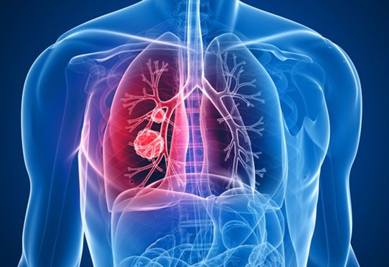 es-verdad-que-el-cancer-de-pulmon-solo-afecta-a-los-fumadores