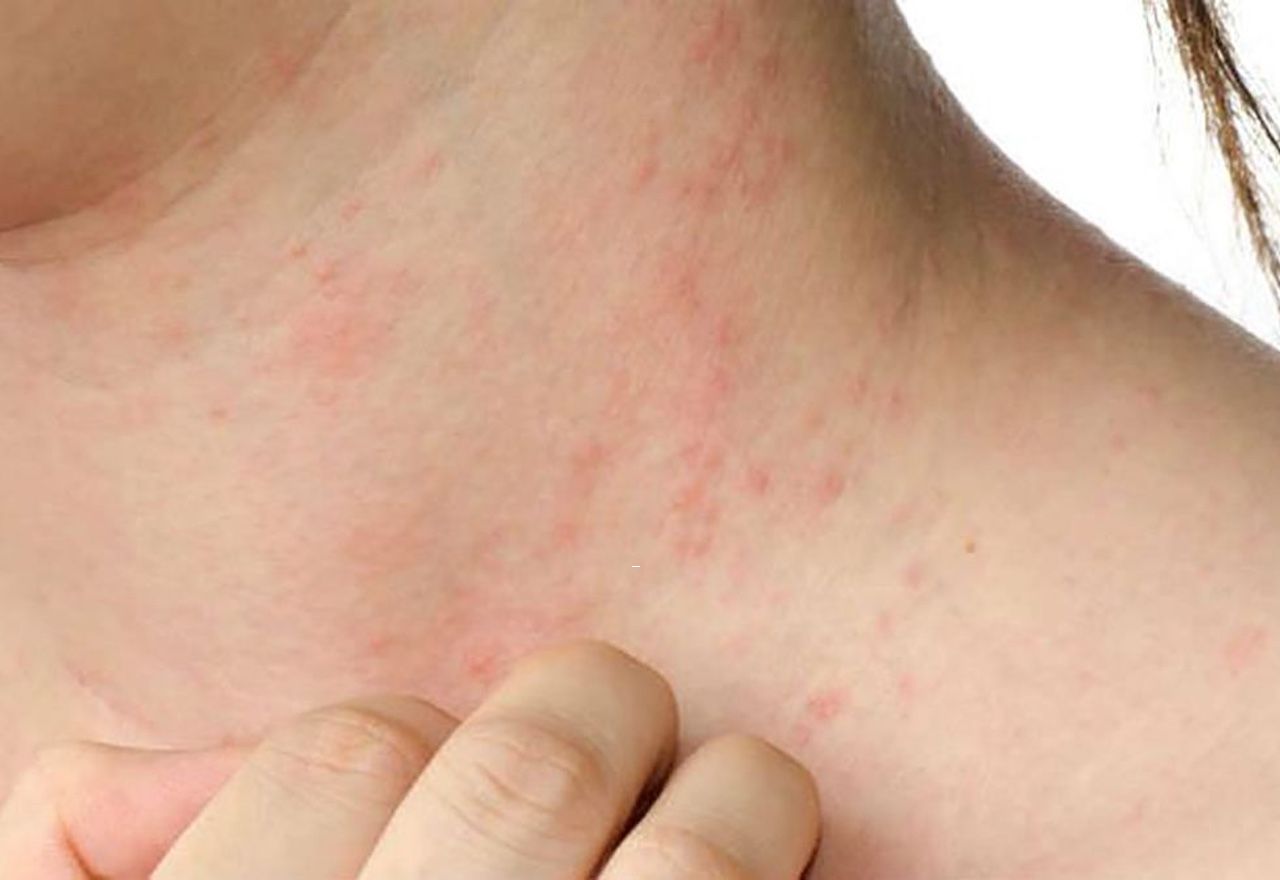 Todo lo que debes saber sobre la dermatitis atópica
