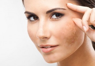 ¿Cómo evitar la aparición de las manchas en la cara?